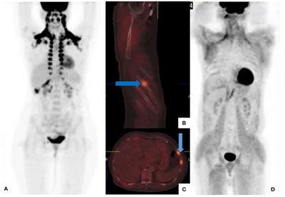 F-18 Fluoro-2-Deoxyglucose Positron Emission Tomography (PET)/Computed Tomography (CT) Imaging in Melanoma: Normal Variants, Pitfalls, and Artifacts